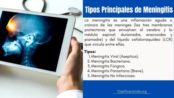Tipos de Meningitis