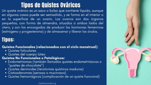 Tipos de Quistes Ováricos